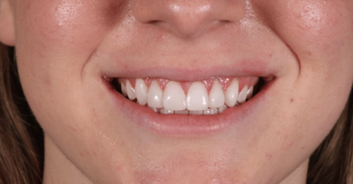 After Teeth Whitening