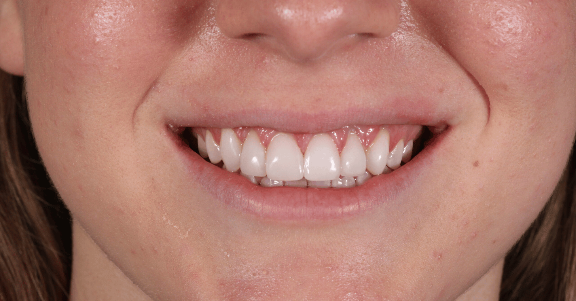 After Teeth Whitening