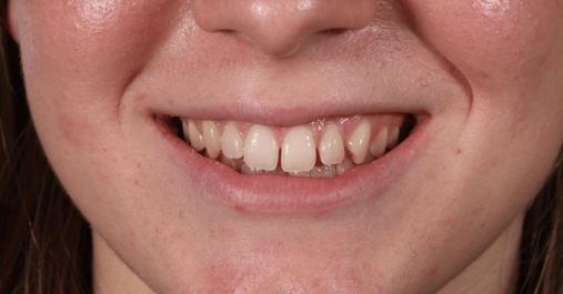 Before Teeth Whitening