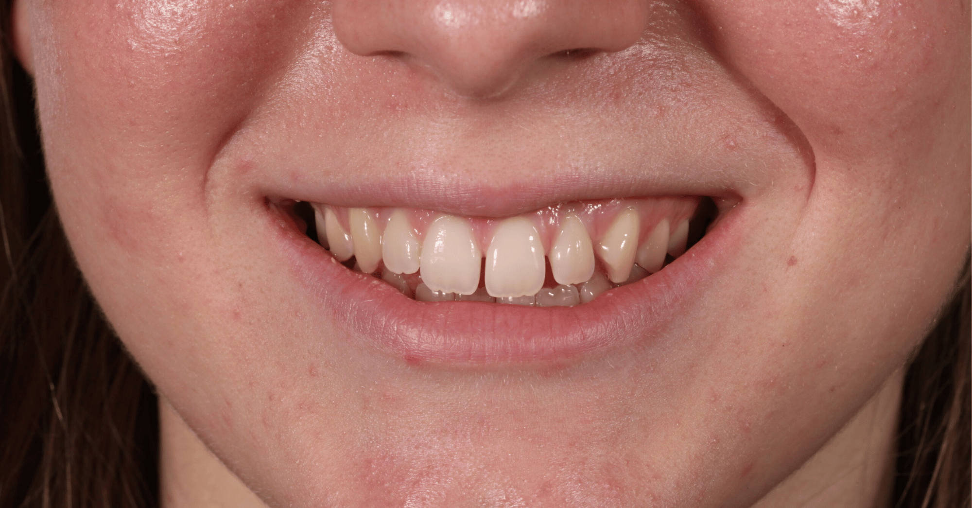 Before Teeth Whitening