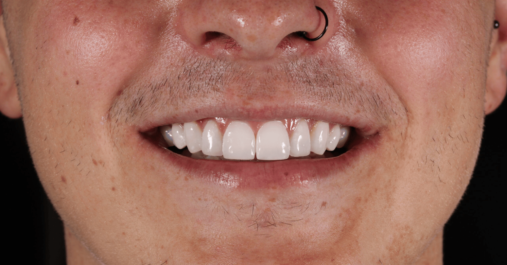 After - Springmount Dental