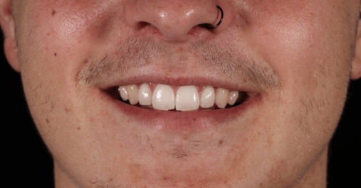 Before - Springmount Dental