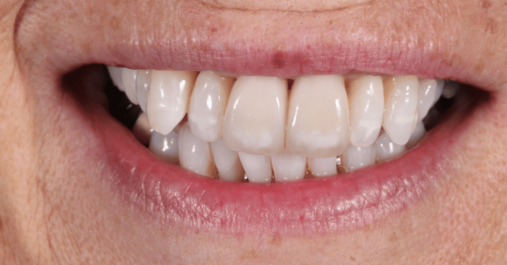 After - Springmount Dental