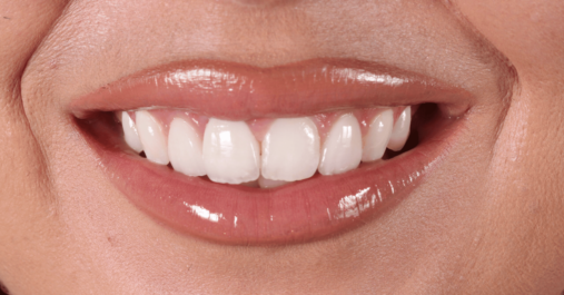 After - Springmount Dental