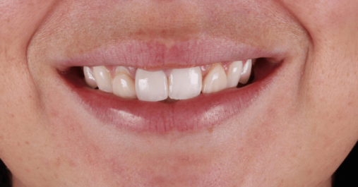 Before - Springmount Dental