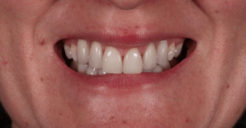 After - Springmount Dental