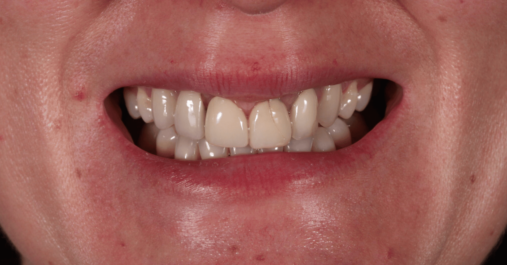 Before - Springmount Dental