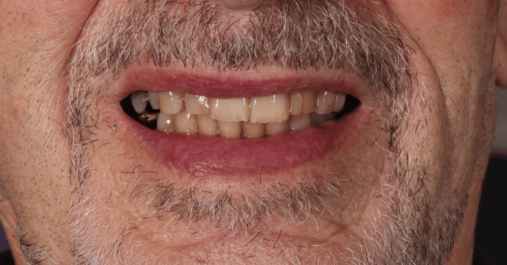 Case 6 after After - Springmount Dental & Aesthetics