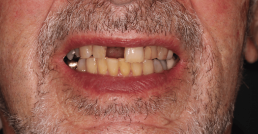 Case 6 before Before - Springmount Dental & Aesthetics