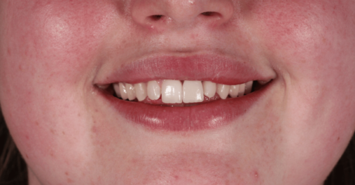 Case 7 after After - Springmount Dental & Aesthetics