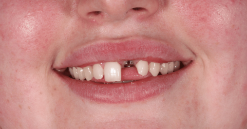 Case 7 before Before - Springmount Dental & Aesthetics