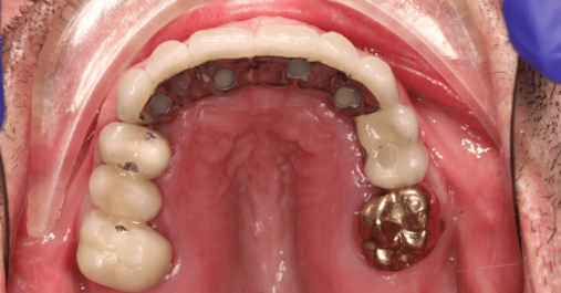 Case 8 after After - Springmount Dental & Aesthetics