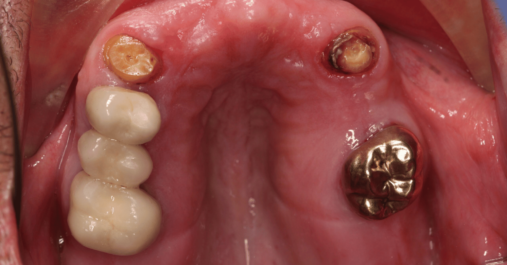 Case 8 before Before - Springmount Dental & Aesthetics