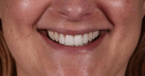 After Veneers