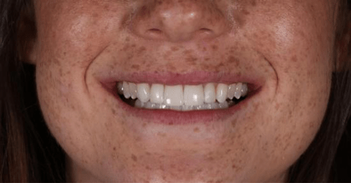 After - Springmount Dental