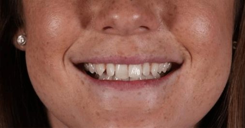 Before - Springmount Dental