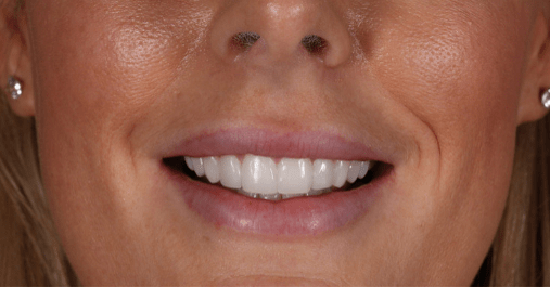 After - Springmount Dental