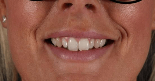 Before - Springmount Dental