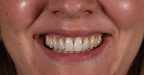 After - Springmount Dental
