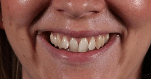 Before - Springmount Dental