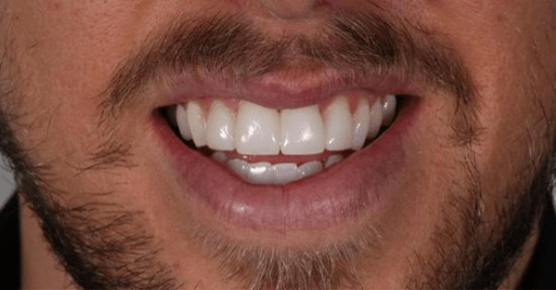After - Springmount Dental