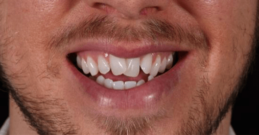 Before - Springmount Dental